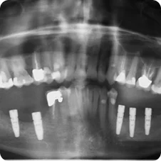 Post-operative Implant Placements