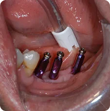 Impressions #18, 19 and 20