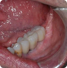 Final - Crown Placements