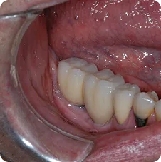 Final - Crown Placements