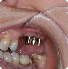 Impressions for Crowns #13, 14, 15, 16 and 18